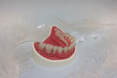 Dentures and their differences Bridges, crowns or implants
