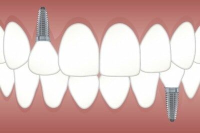 Dental implants What are the different types of dental prostheses?